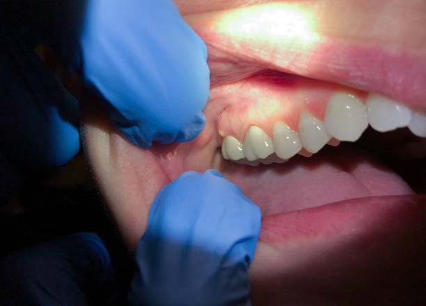Best Emergency Tooth Extraction in Lufkin, TX