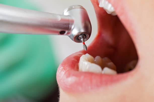 Best Emergency Broken Tooth Repair in Lufkin, TX